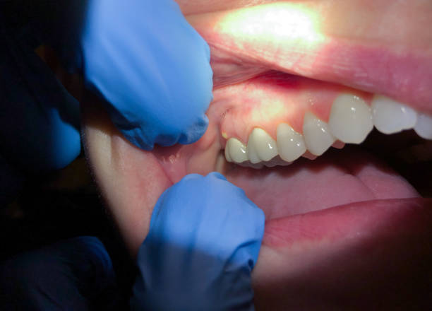 Best Emergency Gum Treatment in Mount Carroll, IL